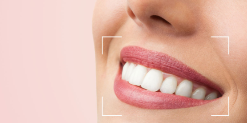 Smile Design (Gülüş tasarımı)