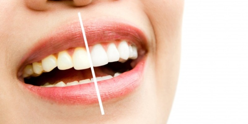 Bleaching (Diş Beyazlatma)